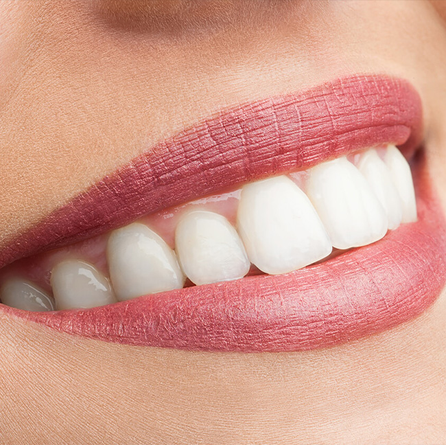 Who Can Have Laminate Veneers? img