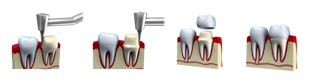Zirconium crown procedure steps from consultation to placement
