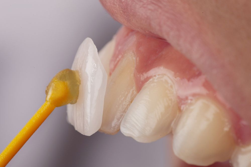 Close-up of laminate veneers on upper front teeth
