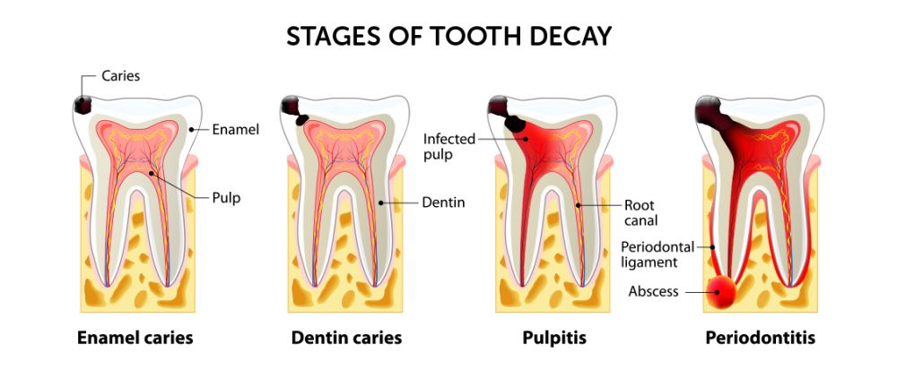 Illustration of root canal treatment showing removal of infected pulp
