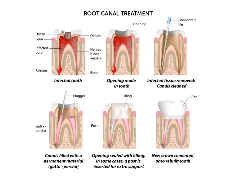 Postroot canal restoration of tooth demonstrating final sealing and shape