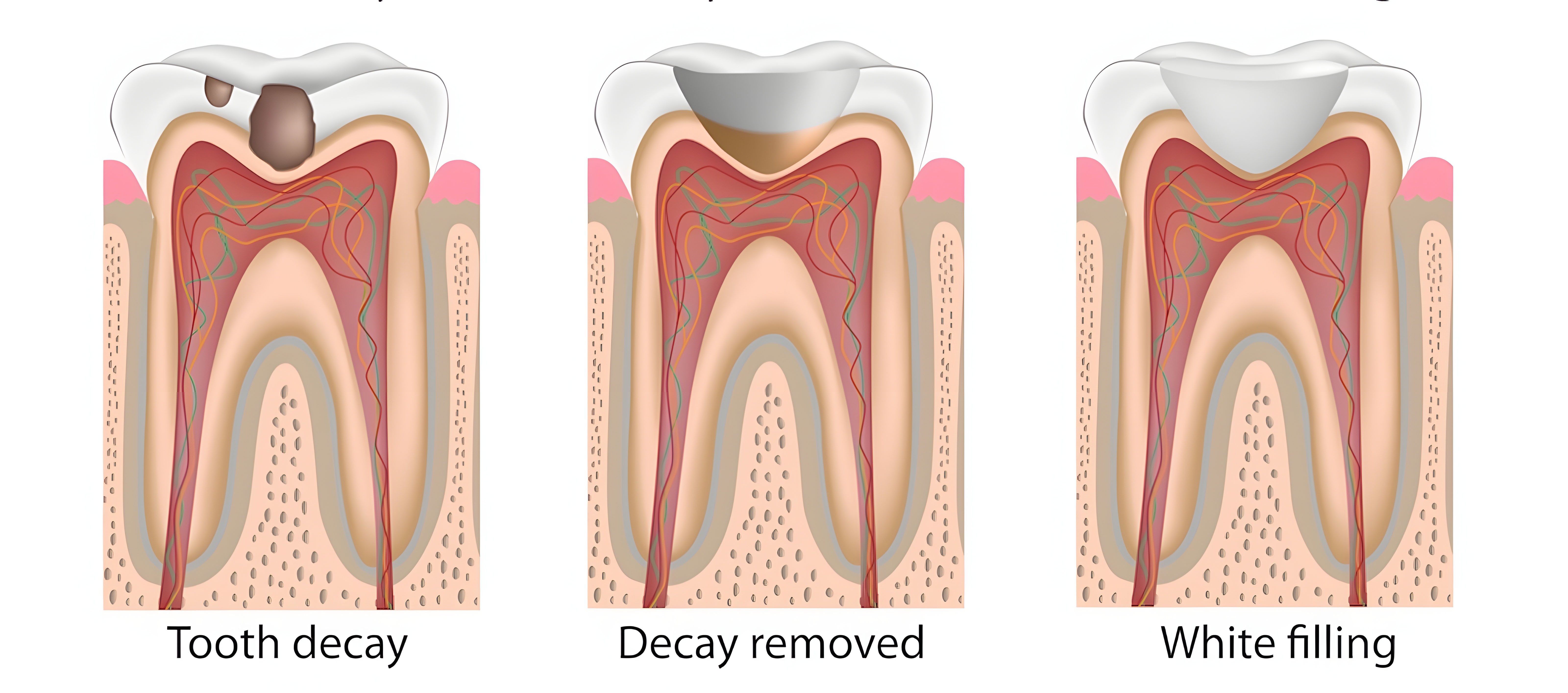 Close-up of composite filling materials and application on a tooth