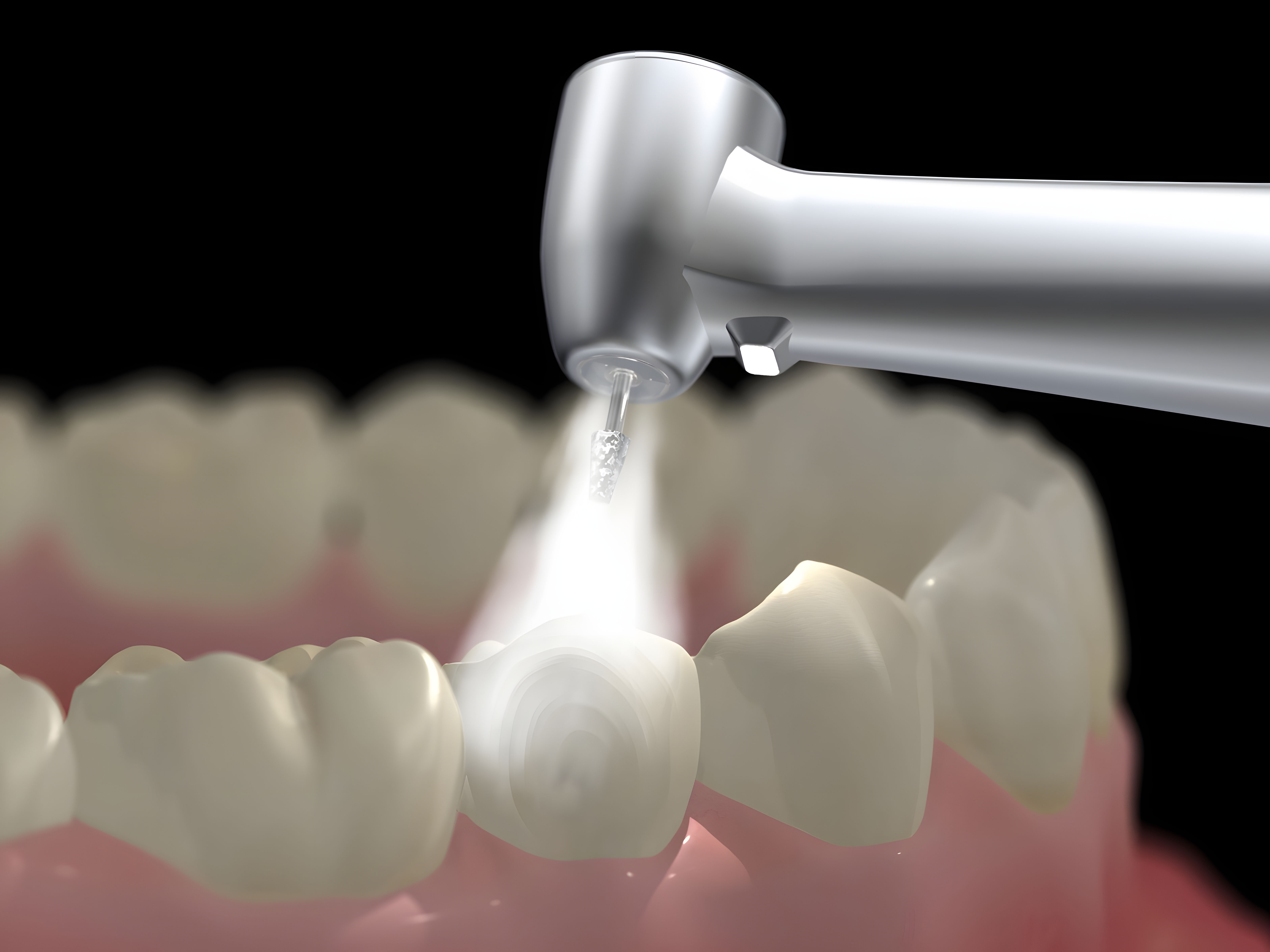 Composite filling treatment at Dentist Kusadasi  aesthetic tooth-coloured restoration