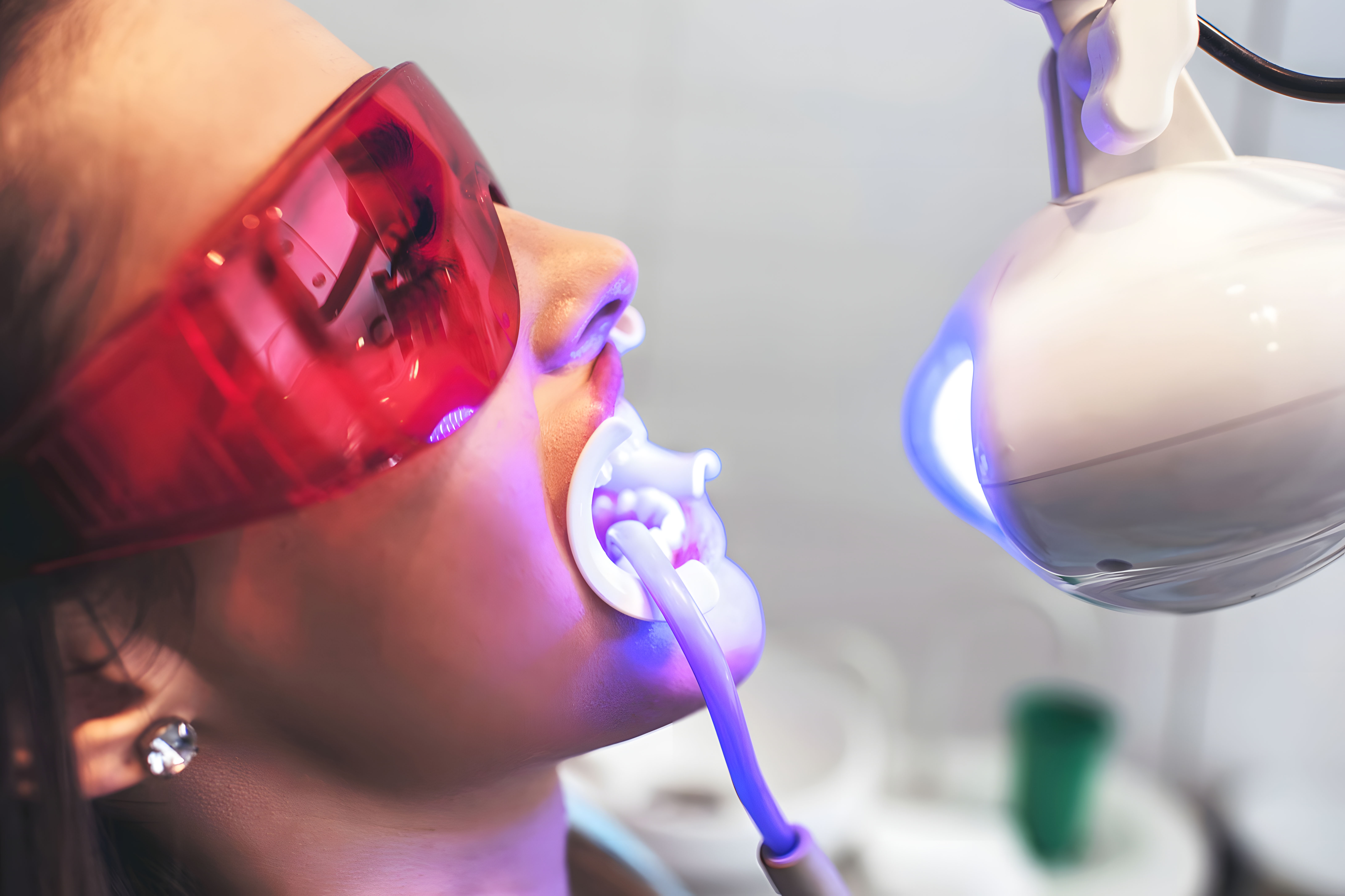 Professional teeth whitening at Dentist Kusadasi with Philips Zoom