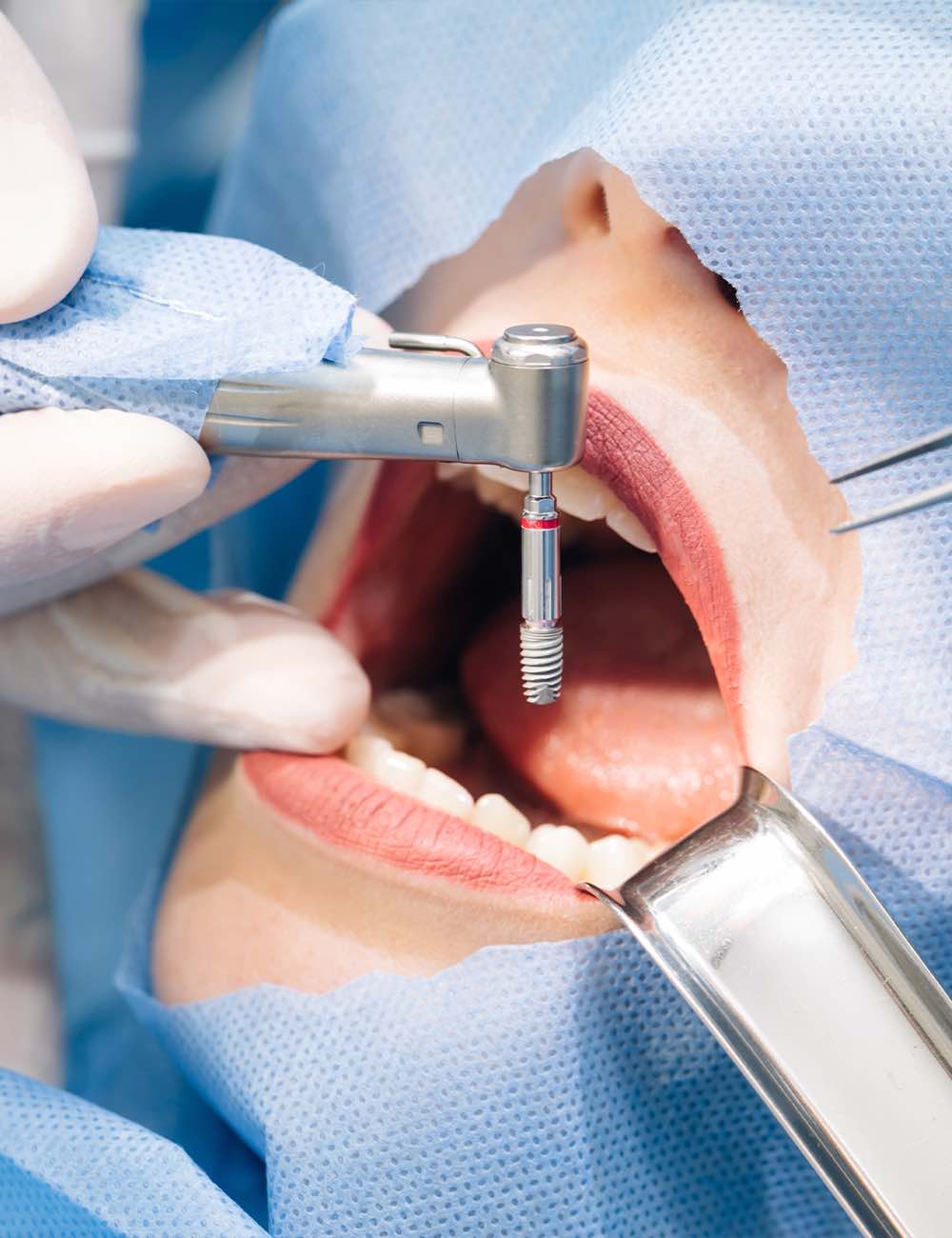 Dental implant placement step