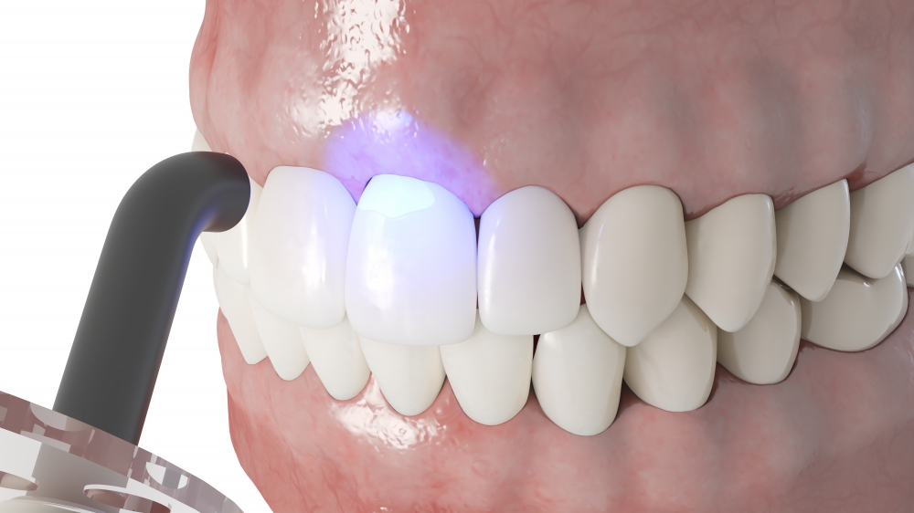 Bonding veneers with composite